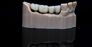 Dental Bridges in Columbus